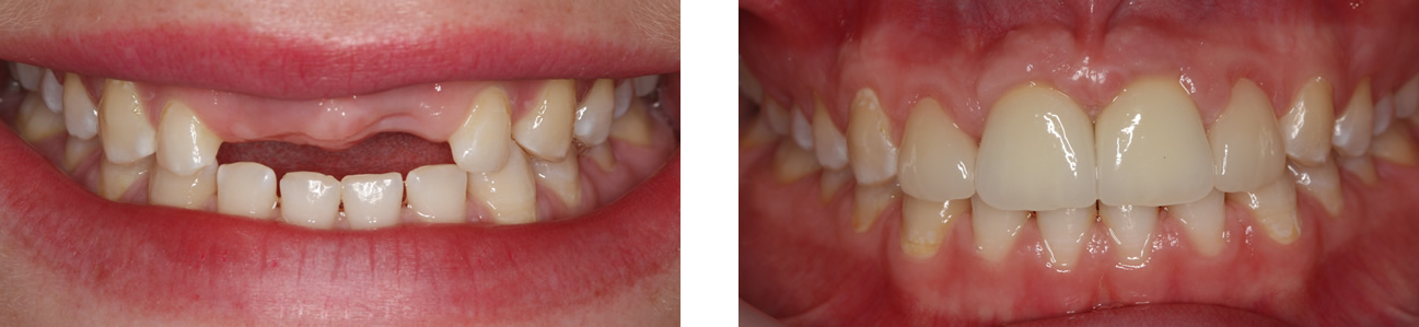 implant-before-after